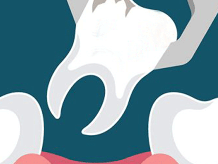 Tooth Extraction colombo, Tooth Extraction wellawatta,  